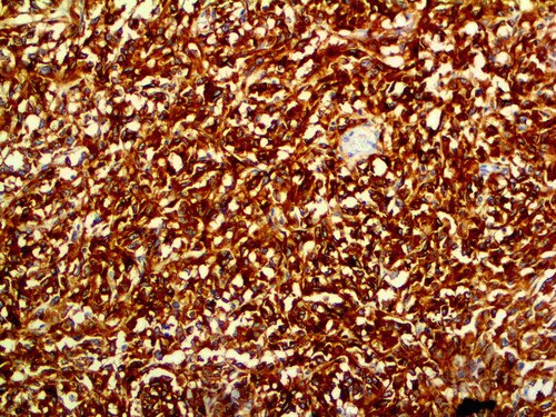 IHC of CD117 on an FFPE GIST Tissue